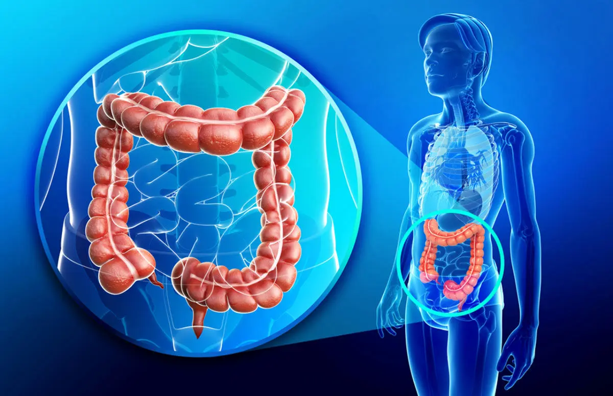 چگونه با تغییرات در رژیم غذایی از سرطان روده بزرگ پیشگیری کنیم؟