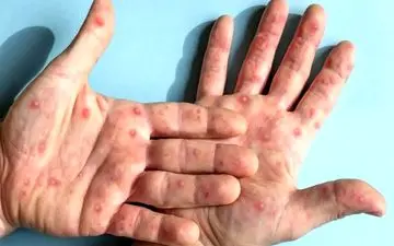 این بیماری در بزرگسالان خطرناک تر است!

