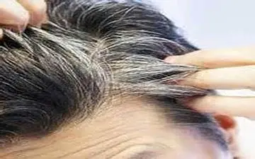 چرا موی سر در نوجوانی سفید می شود؟