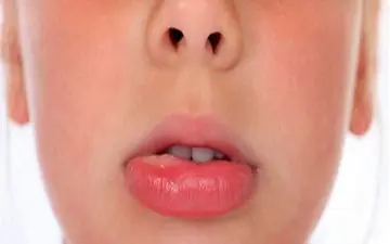ورم بی دلیل لب ، علل و راههای درمان ورم لب 