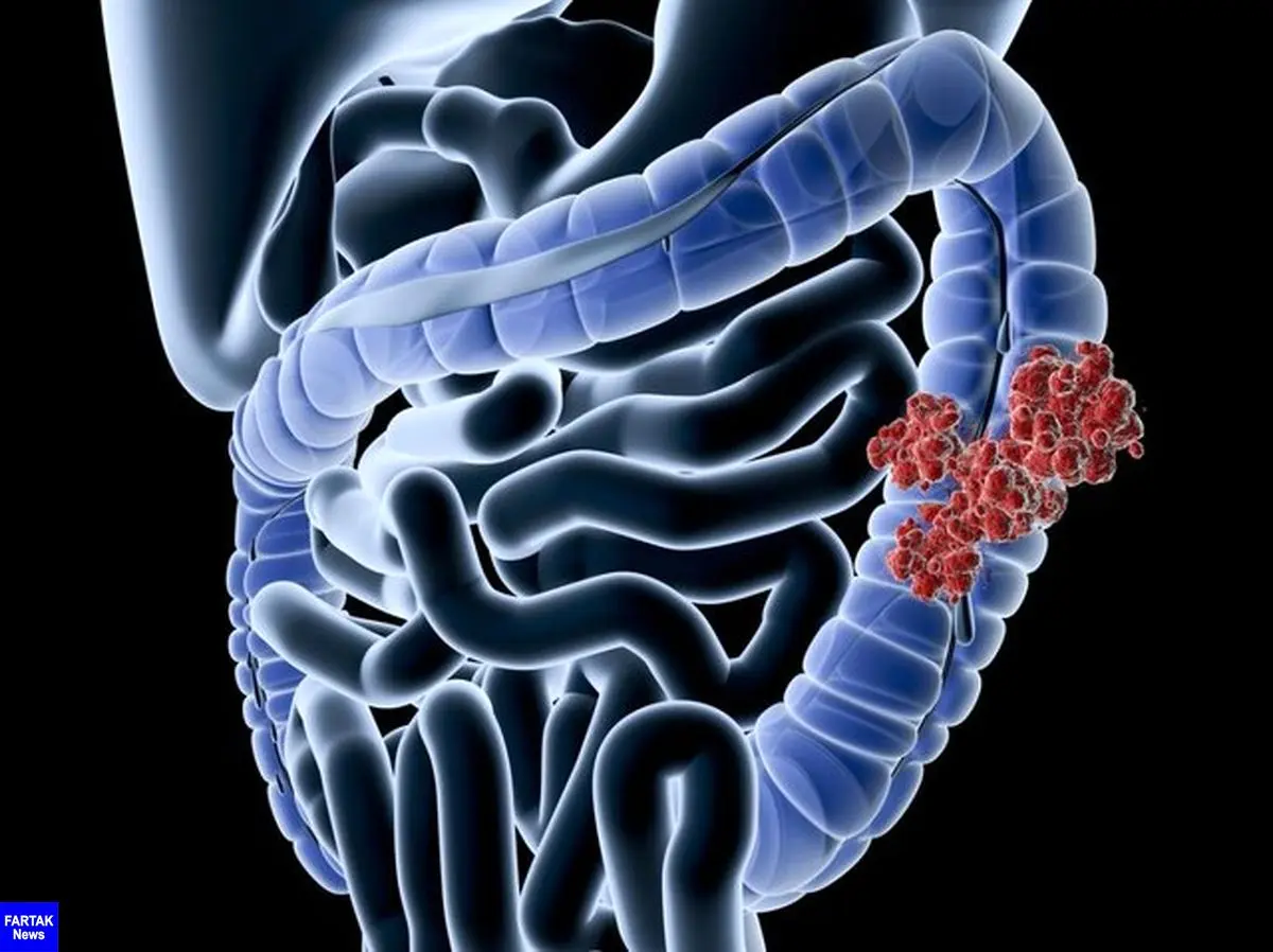 شمار جوانان مبتلا به سرطان روده در جهان افزایش یافته است