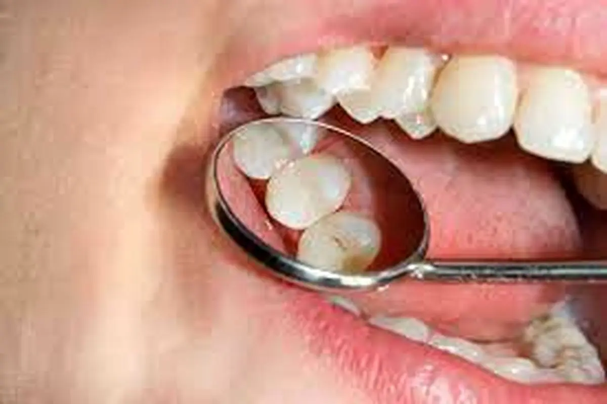 با این روش از پوسیدگی دندان جلوگیری کنید 