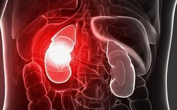 چند روش خانگی برای درمان سنگ کلیه

