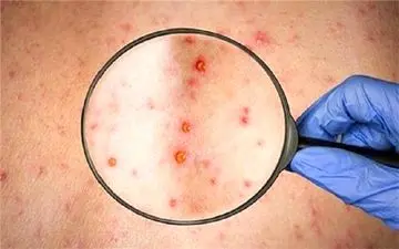 شباهت علائم آبله میمونی و آبله مرغان