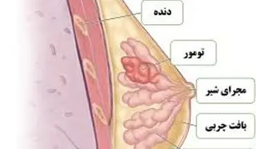 ورزش چه تاثیری بر روند سرطان سینه دارد؟