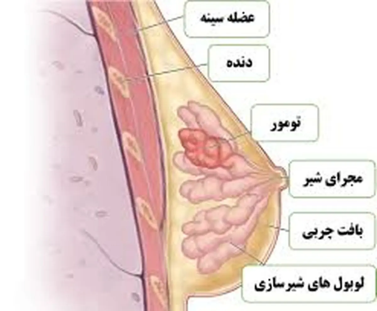 ورزش چه تاثیری بر روند سرطان سینه دارد؟