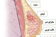 ورزش چه تاثیری بر روند سرطان سینه دارد؟