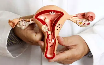 عوارض و خطرات کیست رحم