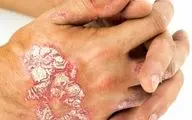 چه چیزی پسوریازیس را تشدید می کند؟