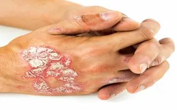 چه چیزی پسوریازیس را تشدید می کند؟