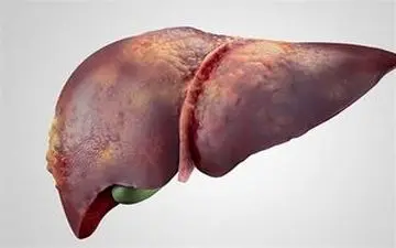 
چه افرادی در معرض خطر ابتلا به کبد چرب قرار دارند؟