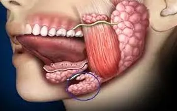 درمان غدد بزاقی با طب سنتی