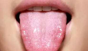 هشدار|  بی حسی زبان را جدی بگیرید!