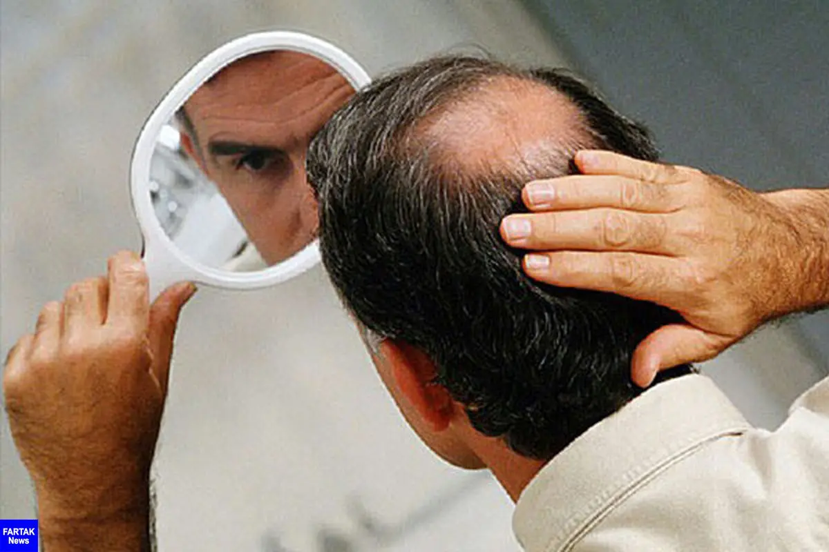 یک متخصص پوست و مو عنوان کرد؛ علت افزایش ریزش ارثی مو در تابستان
