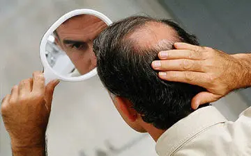 یک متخصص پوست و مو عنوان کرد؛ علت افزایش ریزش ارثی مو در تابستان