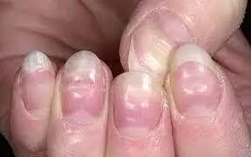 خطرات تهدید کننده بعد از کاشت ناخن!