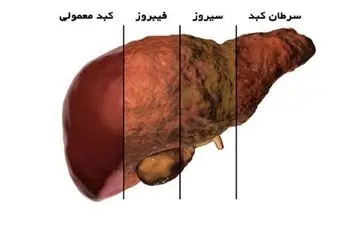 روشی جدید برای تشخیص التهاب کبد