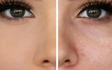 درمان منافذ باز پوست صورت و 12 روش کاربردی خانگی رفع آن