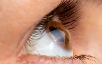 درمان قوز قرنیه چگونه است؟