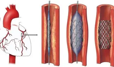 آیا آنژیو قلب خطرناک است؟| اقدامات مهم پیش از آنژیو قلب چیست؟