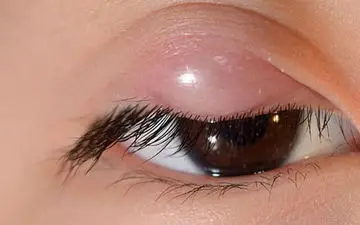 علائم و نشانه‌های گل مژه