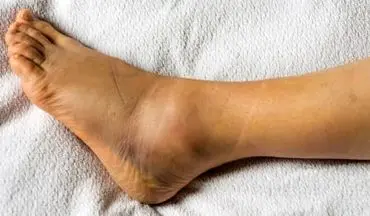 تورم پاها؛ هشداری برای قلب و کلیه