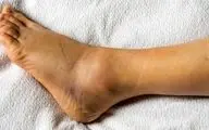 تورم پاها؛ هشداری برای قلب و کلیه