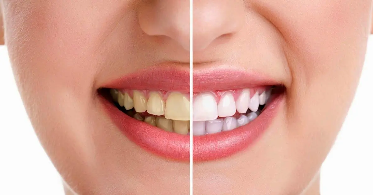 دندان‌های سفید و زیبا با چند روش ساده و طبیعی| چطور با چند ترکیب طبیعی و خانگی دندان‌هایتان را سفیدتر کنید؟
