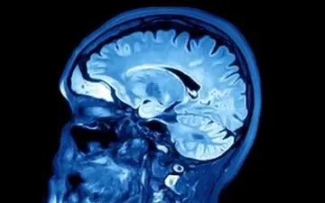 زوال عقل به اندازه ایدز برای سلامت جهان تهدیدکننده است