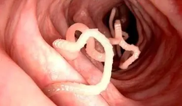 این علائم ساده در کودک تان یعنی به بیماری انگلی مبتلا شده!