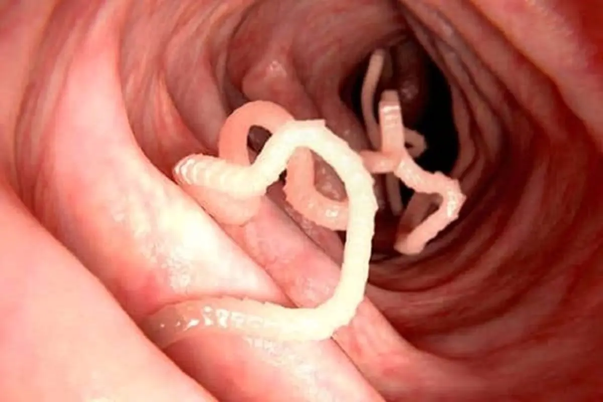 این علائم ساده در کودک تان یعنی به بیماری انگلی مبتلا شده!