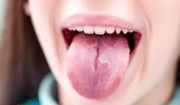 در مورد ترک زبان و علل شیار شیار شدن آن چه می دانید ؟