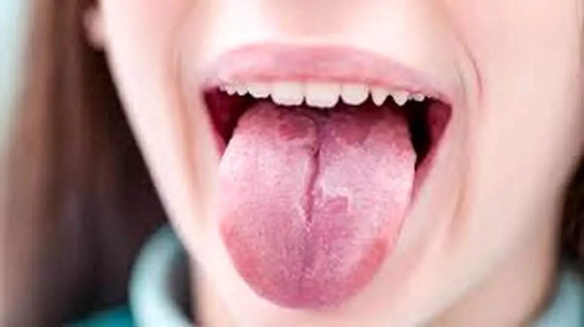 در مورد ترک زبان و علل شیار شیار شدن آن چه می دانید ؟