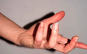 این لکه‌ها و زخم‌ها را جدی بگیرید  ممکن است نشانه مصرف شیشه باشد!