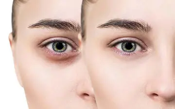  سیاهی زیر و دور چشم | علل ایجاد، جلوگیری و درمان