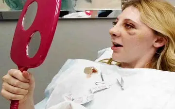 نگرانی برای ورم و کبودی زیر چشم بعد از عمل بینی
