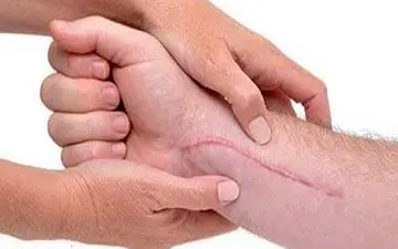 از بین بردن جای زخم به صورت طبیعی
