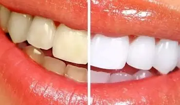 خداحافظی با دندان‌های زرد: ۴ روش ساده برای سفید کردن دندان‌ها در خانه