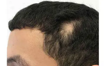 درمان ریزش موی سکه ای بر اساس مزاج

