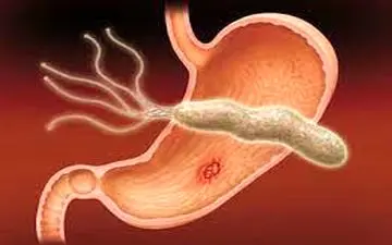 میکروب معده چه علائمی دارد؟ + اینفوگرافی