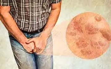 آشنایی با دو بیماری جنسی که در ایران شایع است