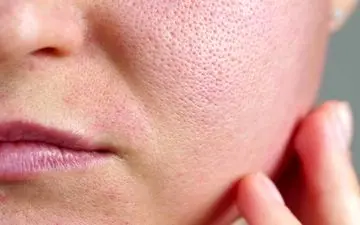 2 روش کارآمد برای کاهش منافذ باز پوست