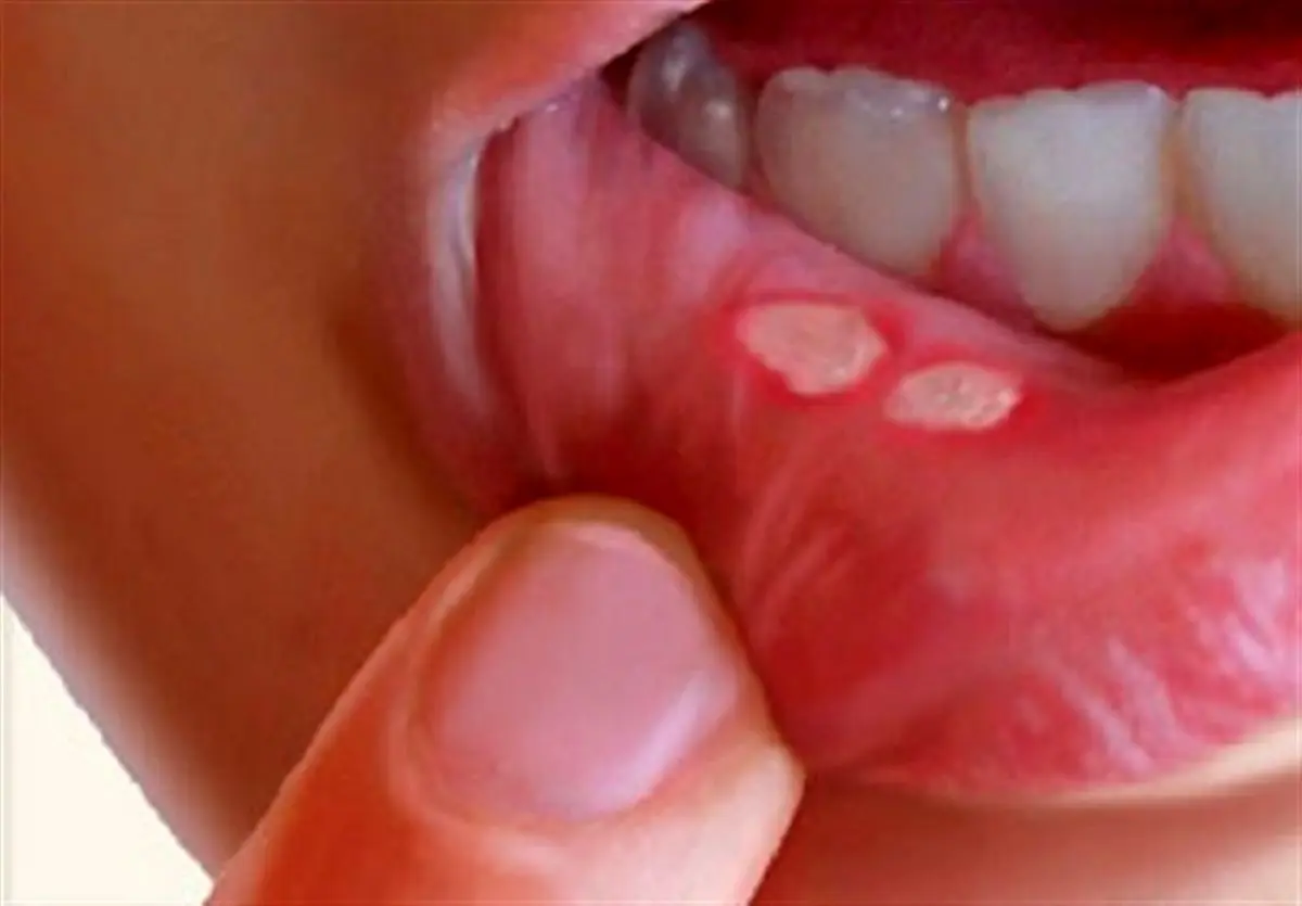 درمان آفت دهان با طب سنتی