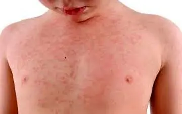  ترفند هایی فوری برای درمان عرق سوز !