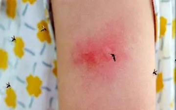 پشه زدگی را با خمیر دندان می توان درمان کرد؟