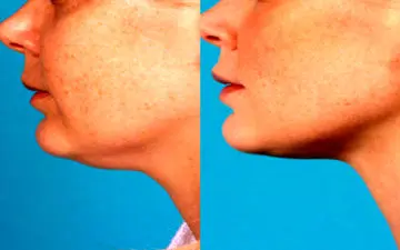 5راه بسیار ساده برای از بین بردن غبغب!