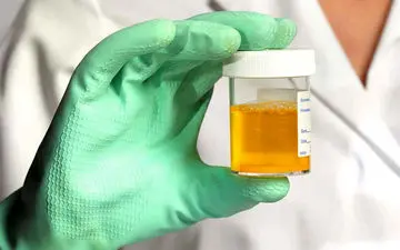 تغییر رنگ ادرار نشانه چیست؟