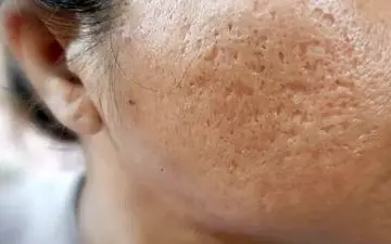 جای زخم را سه سوته درمان کنید