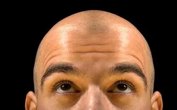 افراد طاس کرونای شدیدتری می گیرند؟