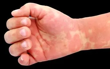 بیماری کاوازاکی چیست؟ | کاوازاکی بیماری خفته در کودکان